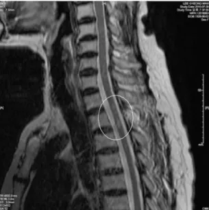 Fig. 1.  MRI of thoracic spine.