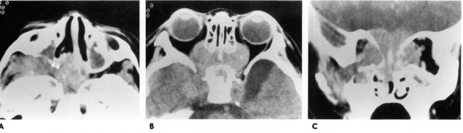 Fig.  3.  3-year old man  with  lymphoblastic  type non-Hodgkin  lymphoma 
