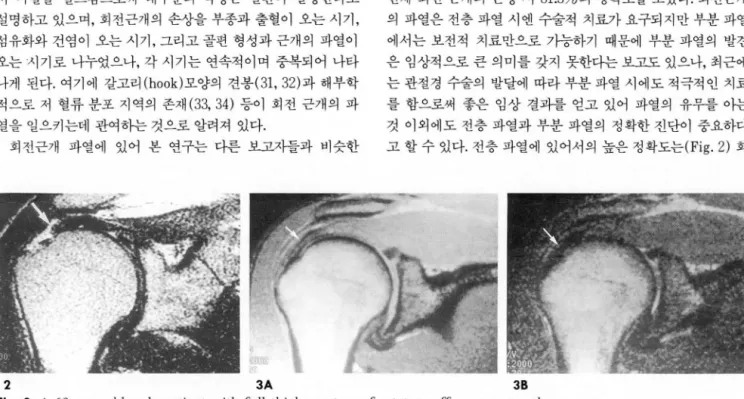 Fig.  2.  A  60-year-이d  male  patient  with  full  thickness  tear  of rotator  cuff proven  at  arthroscopy 