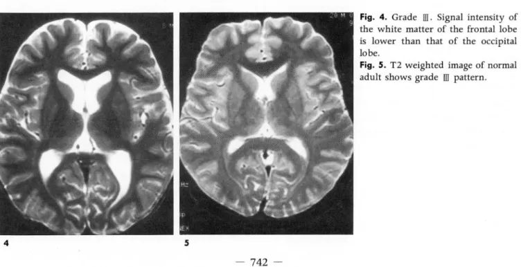 Fig.  2.  Grade  1.  Signal  intensity of the  white  matter  of the occipital  lobe  is  lower than  that  of the  frontal  lobe