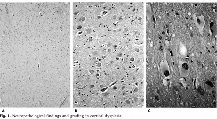 Fig.  1.  Neuropathological  findings  and  grading  in  cortical  dysplasia. 