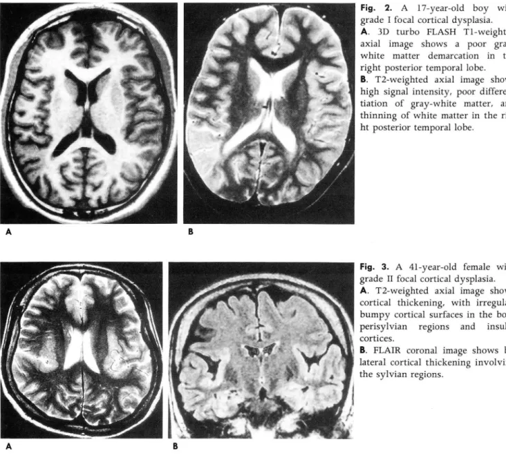 Fig.  3.  A  41-year-old  female  with  grade  II  focal  cortical dysplasia. 