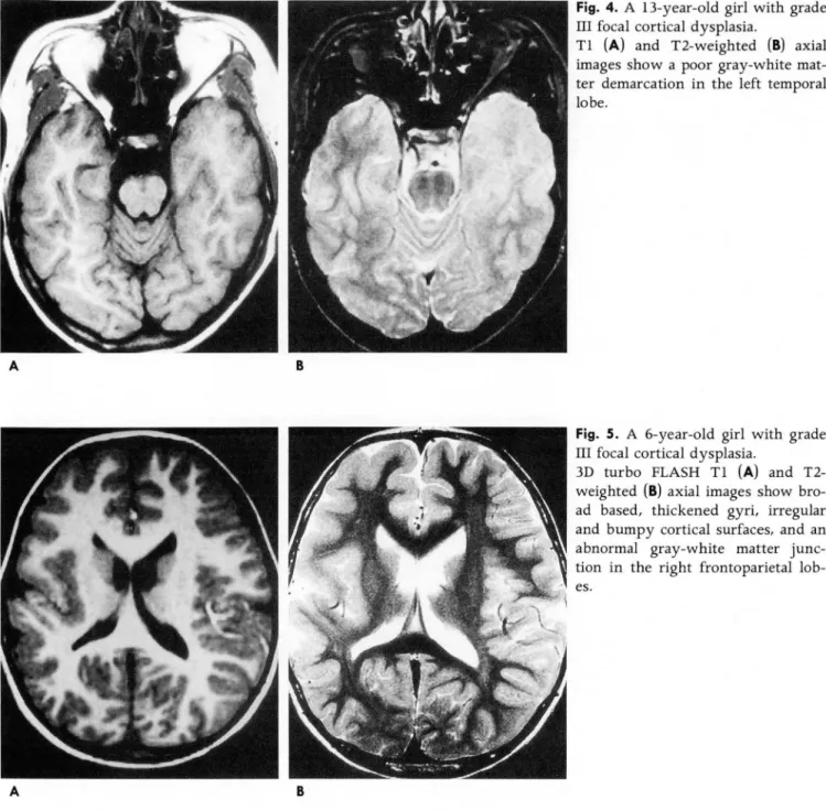Fig.  4.  A  13-year-이d  girl  with  grade 