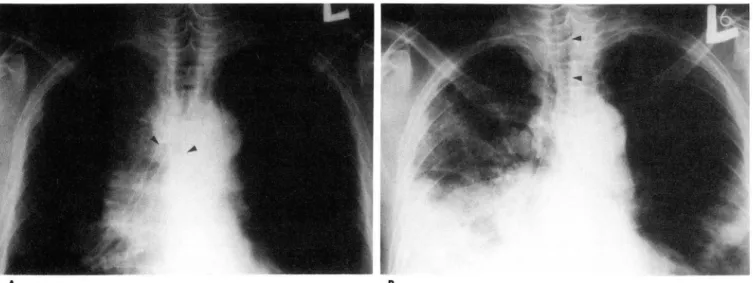Fig.  2.  A  50-year-old  man  with  primary  lung  cancer  with  stent migration 