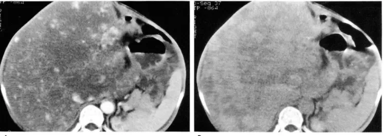 Fig.  4.  Follow-up  multiple  phase  bolus  dynamic  CT  obtained  14  years  late r