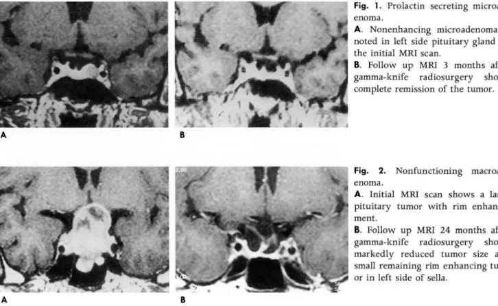 Fig.  1.  Prolactin  secreting  microad- microad-enoma. 
