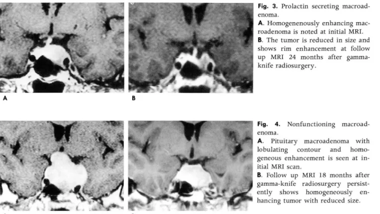 Fig.  3.  Prolactin  secreting  macroad- macroad-enoma 