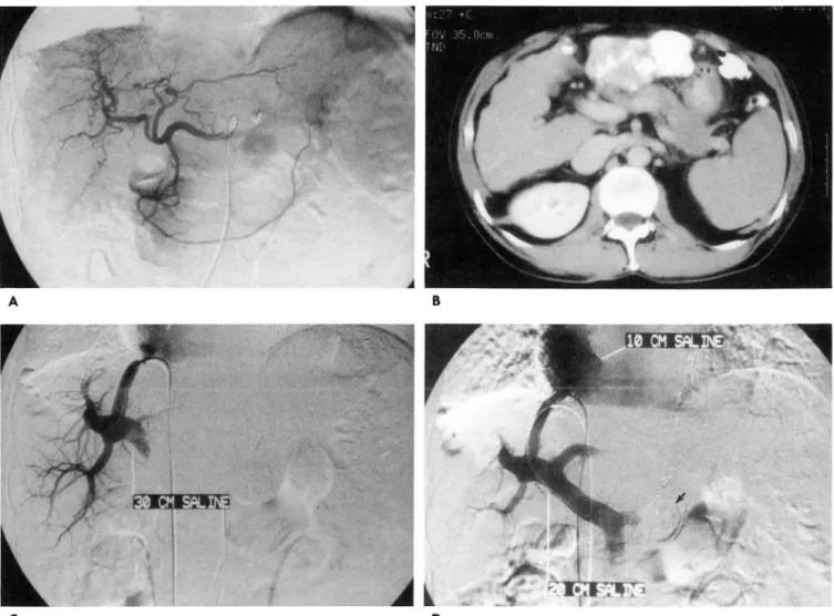 Fig.  2.  A.  Hepatic  arteriogram  shows  a  round  tumor  staining in  the  segment  3