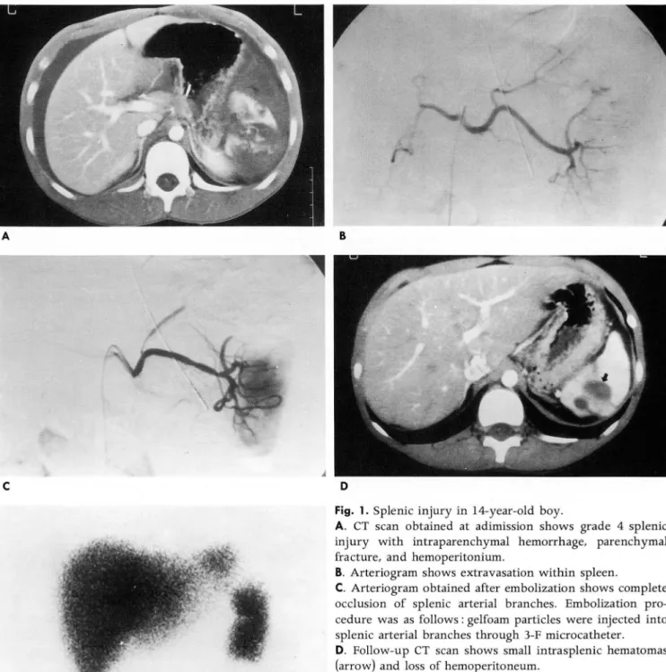 Fig.  1.  Splenic  injury  in  14-year-old  boy. 