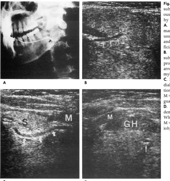 Fig.  1.  Normal  anatomy  of  the  left  submandibular  duct  using   continu-ous  injection  of saline  via   sialograp-hy  needle