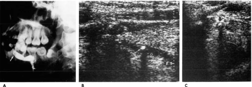 Fig.  2.  Stone  in the  distal  Wharton ’ s  duct  in  14-year-old  woman. 