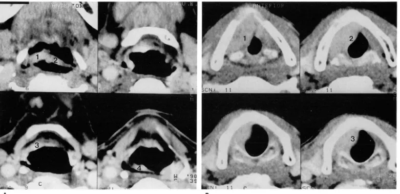 Fig.  1.  Analysis  of degree  of tum or extension  using  the  concept  of anatomic subsites 