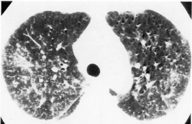 Fig.  2.  Case  6.  In  right  middle  lung  zone ,  an  area  of focal  patchy  consolidation  with  air  bronchogram  is   dem-onstrated  (open  arrow)