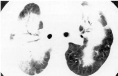 Fig .  S.  Case  12.  Conventional  CT  scan  shows  extensive  consolidation  with  air  bronchogram  in  both  middle  lung  zones