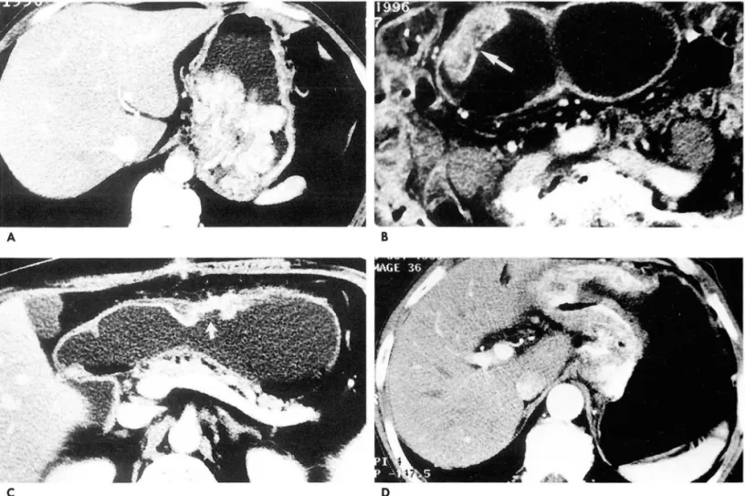 Fig.  1.  Borrmann ’ s  classification of advanced  gastric  carcinoma(AGC). 