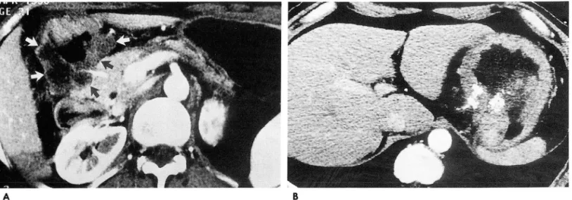 Fig.  3.  Advanced  gastric  carcinoma,  mucinous  type . 