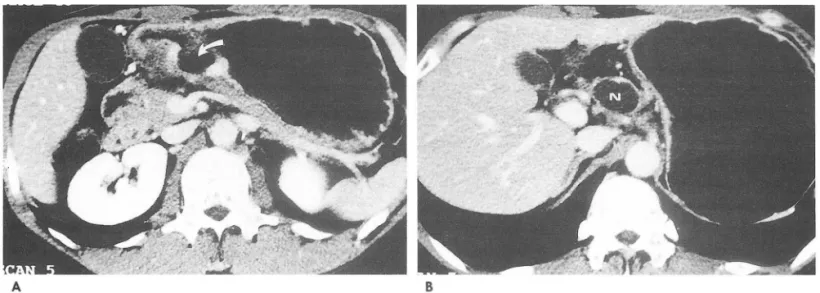 Fig.  7.  Advanced  gastric  carcinoma  with  multiple  lymph  nodes  metastasis 