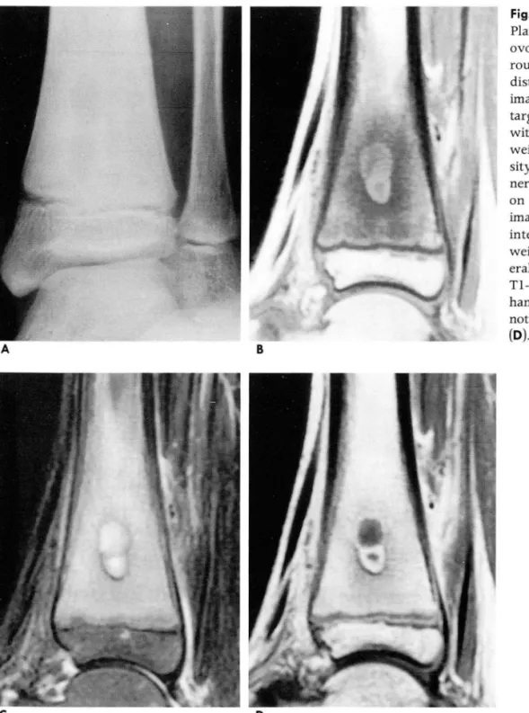 Fig.  1.  Type 1 Brodie ’ s abscess  Plain  radiograph  (A)  shows  an  ovoid  osteolytic  lesion  with   sur-rounding  endosteal  sclerosis  in  the  distal  tibia