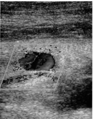 Fig.  2.  Color  Doppler  sonogram  showing  the in f1 0w  (small  arrows) ,  out f1 ow  (I arge  arrows) ,  and  central  vortex