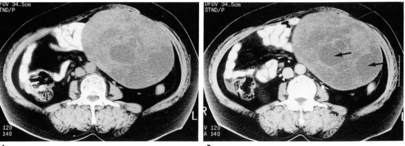 Fig.  2.  Case  1.  A  61-year  old  patient with  a  palpable  lower  abdominal  mass  for  several  months 