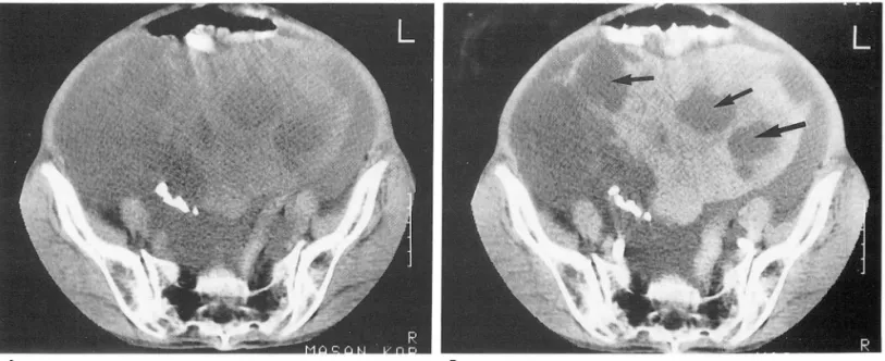 Fig.  6.  Case  8.  A  62-year old  patient  complained  of abdominal  distension  for  1 month 