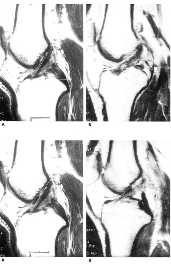 Fig.  1.  A.  Sagittal  proton  density  weighted  (TR:  2000/TE: 30)  MR  image  of a  normal  ACL  shows  the  ACL  angle  of  60 0