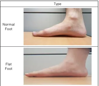 Table  1.  Normal  Foot  and  Flat  Foot