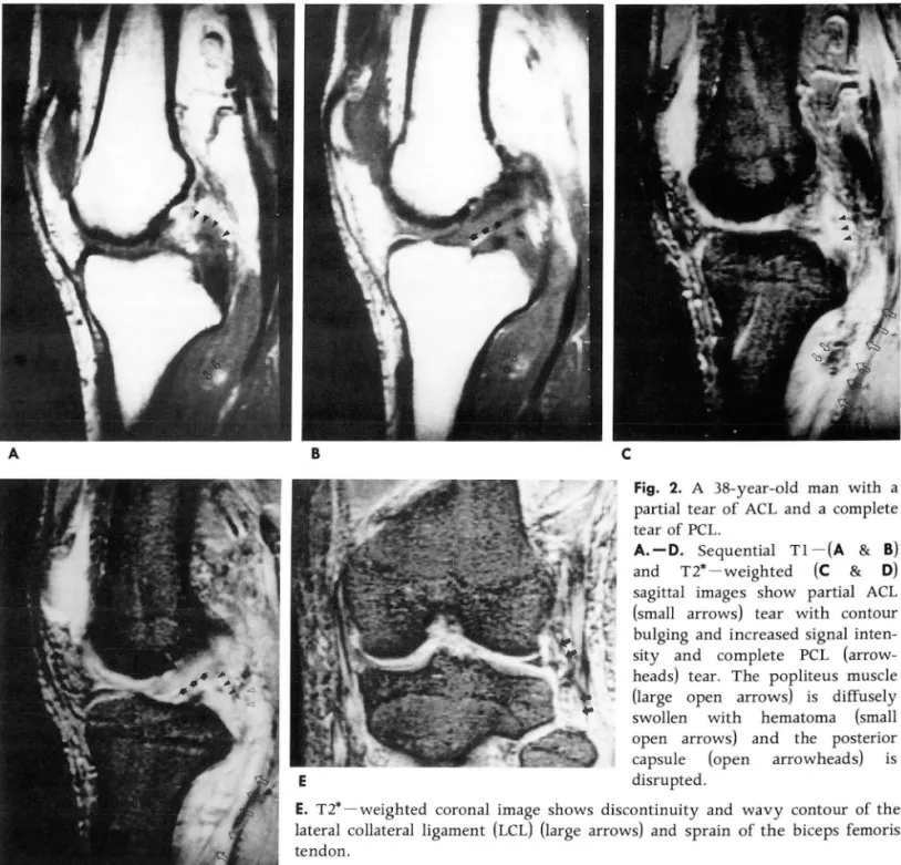 Fig.  2.  A  38-year-old  man  with  a  partial  tear  of ACL  and  a  complete  tear  of PCL 