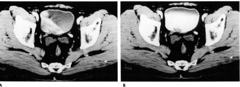 Fig.  2.  CT  scans  of delayed  phases  in  two  different  times  after injection of contrast materia l