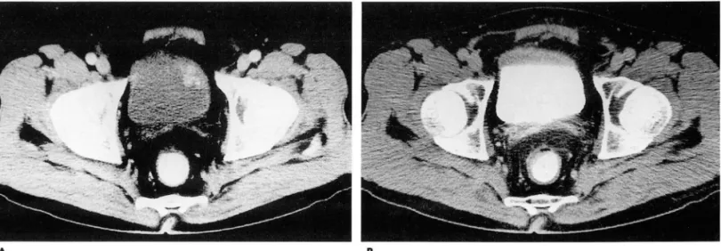 Fig.  3.  CT  scans  of early  and  delayed  phases  of postcontrast  CT  scan  from  55  year-이 d  man  with  transitional  cell  carci- carci-noma 