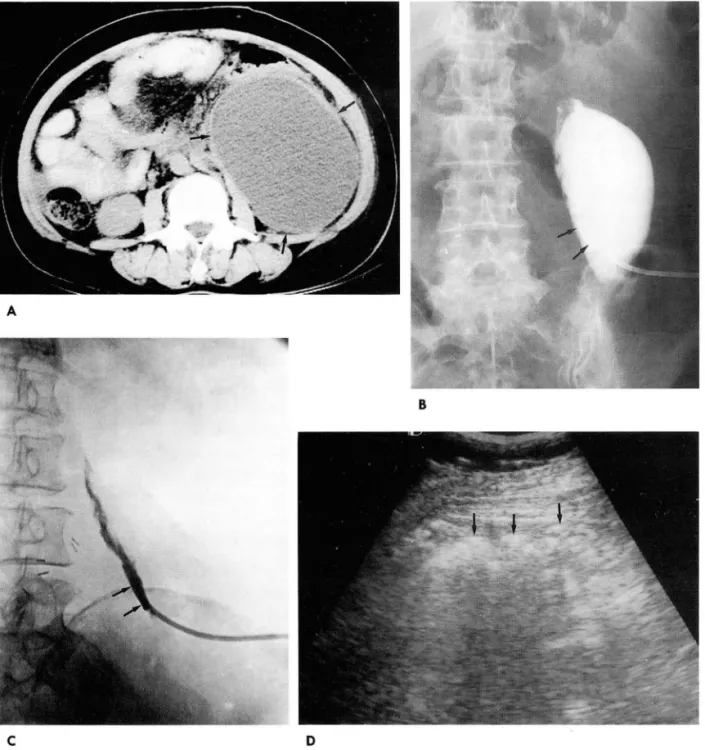 Fig.  1.  Sterile  lymphocele 