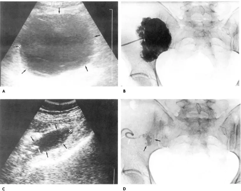 Fig.  2.  Infected  lymphocele 