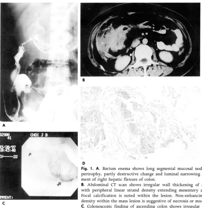 Fig.  1.  A.  Barium  enema  shows  long  segmental  mucosal  nodularity  and  hy- hy-pertrophy,  partly  destructive  change  and  luminal  narrowing  in  the  long   seg-ment  of right  hepatic  f1 exure  of colon