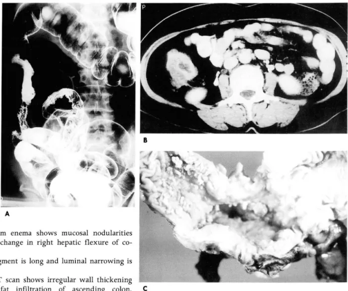 Fig.  2.  A.  Barium  enema  shows  mucosal  nodularities  and  d estructive  change  in  right  hepatic  flexure  of  co  lon