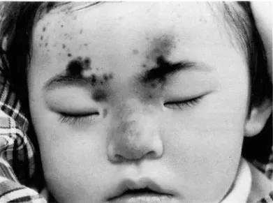 Fig.  1.  Two  years  old  girl  with  characteristic  linear distri- distri-bution  of  soft  yellowish  papules  of  sebaceous  nevus  on  the  midface