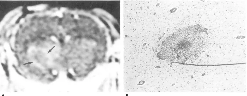 Fig.  2.  Late  cerebritis  stage  of brain  abscess  in  the  rabbit 