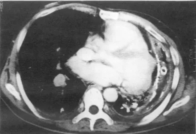 Fig.  1.  50  year-old  male  patient  with  tuberculous  pleural  effusion  confirmed  by  pleural  biopsy