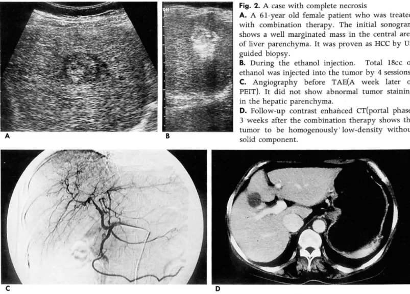 Fig.  2.  A  case  with complete  necrosis 