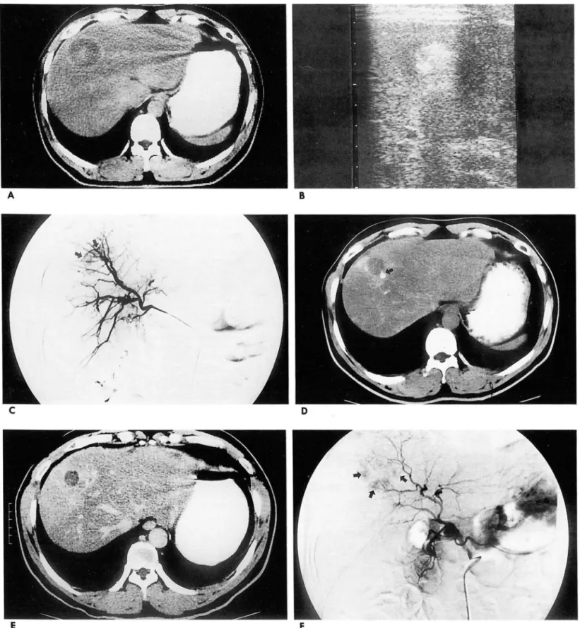 Fig .  3.  A  case  with incomplete  necrosis. 