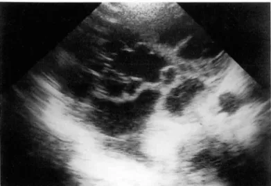 Fig.  3.  Tuberculous  pleural  effusion  in  32-year-old  wo-