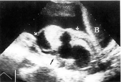 Fig.  1.  Left  struma  ovarii  with  hyperthyroidism  in  a  65  year-old  female  patient  (No