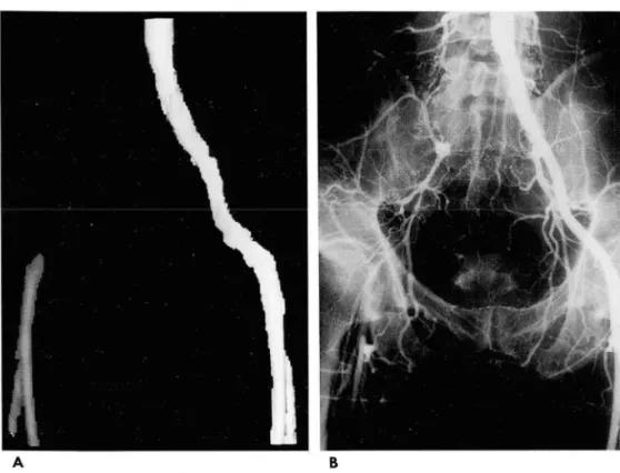 Fig.  1.  Total  occlusion  of the  right  common  iliac  artery  in  a   68-year-old  man