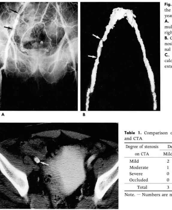 Fig.  2.  MultifocaL  severe  stenoses  of  the  right  external  iliac  artery  in  a  57  year  old man