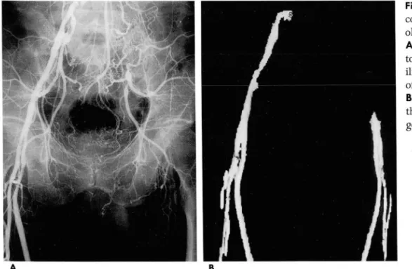 Fig.  3.  Total  occlusion  of  the  left  common  iliac  artery  in  a   65-year-old man