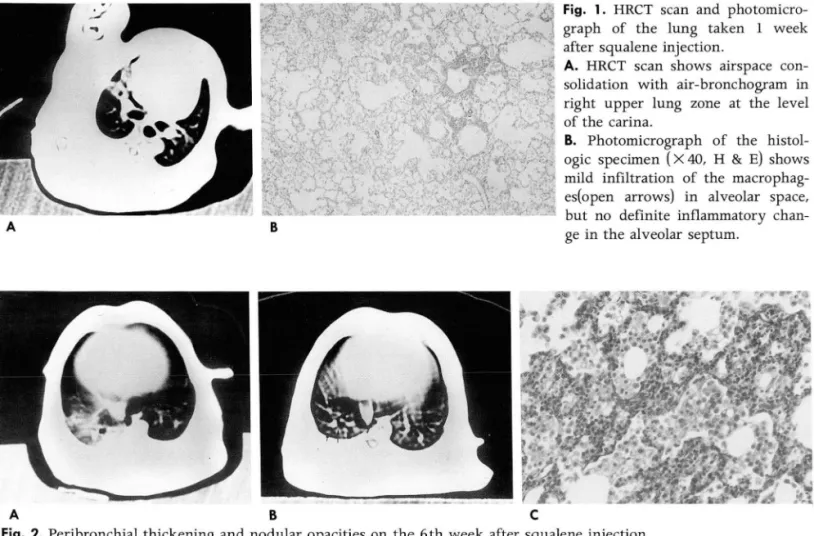 Fig.  2.  Peribronchial thickening and  nodular  opacities  on  t he  6th  week  after  squalene injection