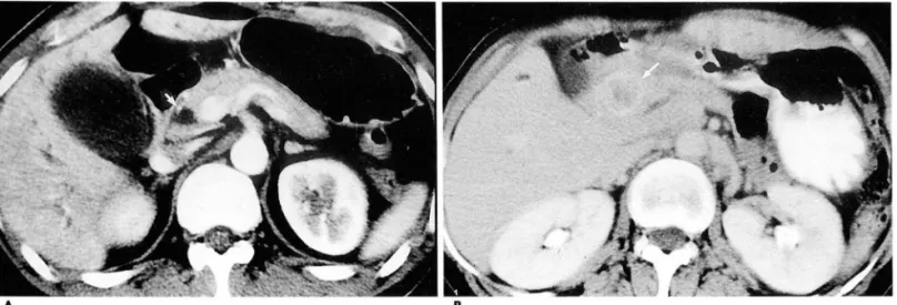 Fig.  1.  Cases'of Low-score(0 - 2)  CT  Severity  Index(CTSI). 