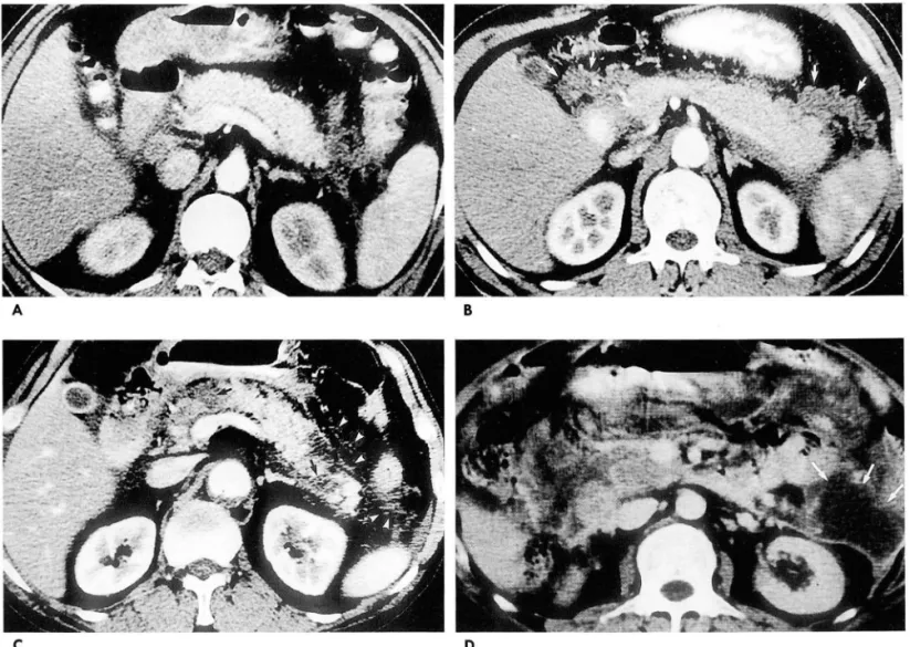 Fig.  2.  Cases  of Middle-score(3 - 6)  CT  Severity Index(CTSI) . 