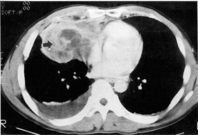 Fig.  2.  Postcontrast  CT  scan  shows  a  large,  low- low-attenuated  solid  mass  with  ill-marginated  high   attenu-ation(arrow)  and  bilateral  pleural  effusion