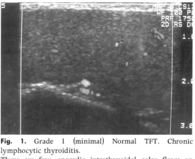 Fig.  3.  Grade  3  (marked)  Increased  TFT.  Graves'  disease  There  are  markedly  increased  color f10ws  throughout  the  entire  gland  on  axial  CD I
