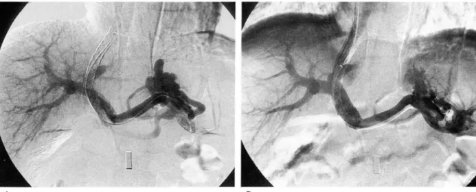 Fig.  2.  Revision  of TIPS  in  a  49-year-old  man  with  recurred  variceal  bleeding  4  months  after  initial  TIPS  placement